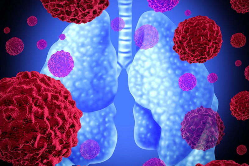 Обнаружены мутации рака легких, восприимчивые к таргетированным и иммунным терапиям